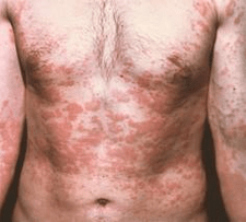 Το προβληματικό δέρμα είναι σύμπτωμα της παρουσίας παρασίτων