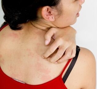 κοκκιώματα στο σώμα - συμπτώματα της παρουσίας παρασίτων