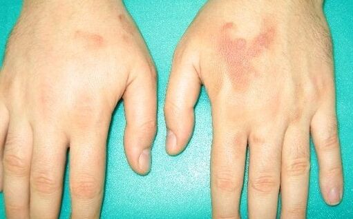 ο πόνος στις αρθρώσεις των χεριών μπορεί να είναι συμπτώματα παρασίτων