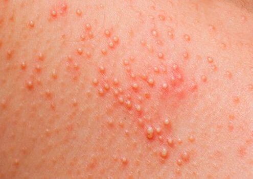 Εάν το σώμα προσβληθεί από παράσιτα, εμφανίζεται μια δερματική αλλεργία